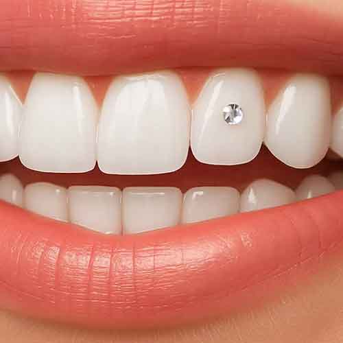 Tooth gem